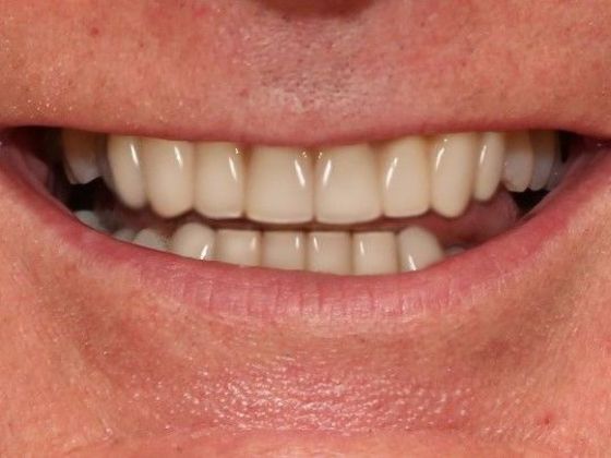After Dental Crowns